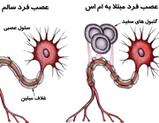 رابطه عصبانیت با بیماری ام اس